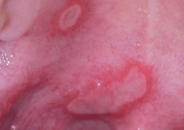 burn on roof of mouth