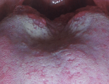 swollen-taste-buds-on-tongue-1