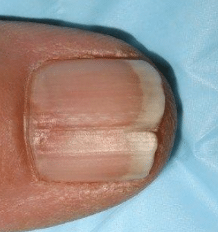 vertical ridges on fingernails
