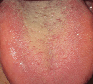 yellow coating on tongue