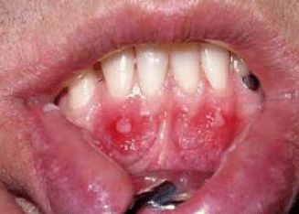 canker sore on gums causes