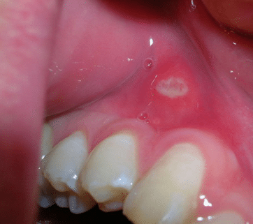canker sore on gums picture