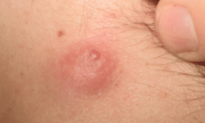 cyst-on-neck-picture-1