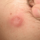 cyst-on-neck-picture-1