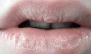 dry-lips-causes-1