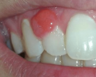 canker sore on gum treatment