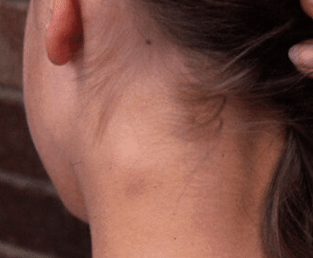 symptoms of a neck cyst