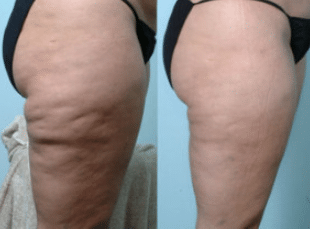 how to get rid of cellulite fast