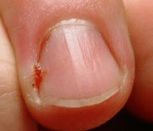 infected hangnail causes
