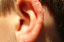bumps-on-ears-1