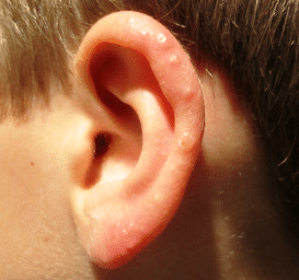 bumps on ears causes