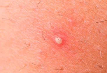 Red bumps on leg