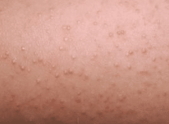 Bumps on legs that are itchy