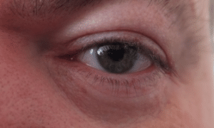 How-to-make-a-swollen-eyelid-go-down-1