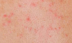 Red-spots-on-breast-2-1