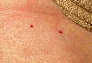 Causes of red spots on reast