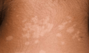 White-spots-on-skin-from-sun-1