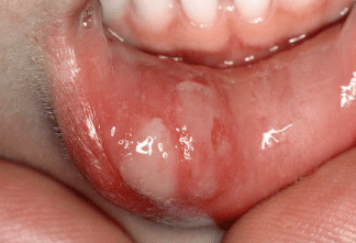 Fast mouth ulcer treatment