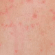 tiny-red-spots-on-skin-1