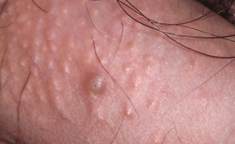 One pimple on penis