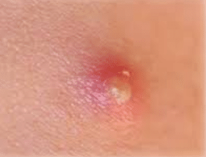 Red pimple on my penis