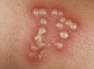 Pimples the of penis rid get to on How to