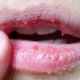 Cracked-lips-1