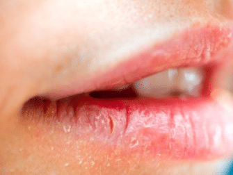 Causes of cracked lips