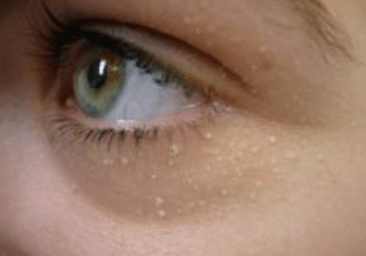 Causes of milia under eye