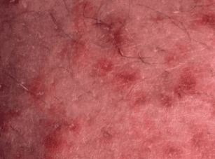Red rash on penis after sex