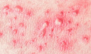 Red-bumps-on-penis3-1