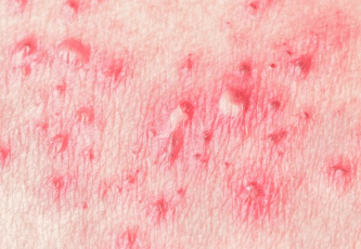 Red-bumps-on-penis3-1