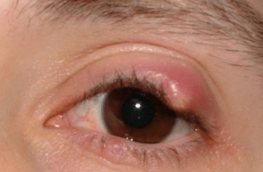 White spot on upper eyelid Treatment