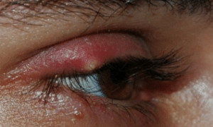white-bump-on-eyelid-treatment-1
