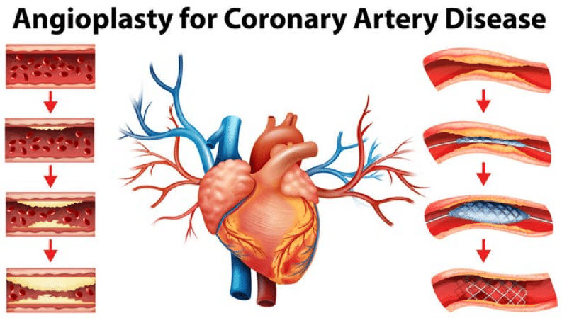 Angioplasty for coronary artery disease