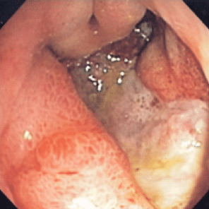 Do I have gastritis? What are the diagnostic tools for Gastritis?