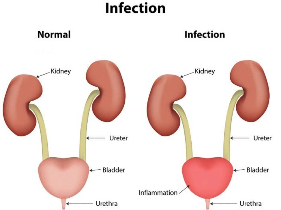 Urinary Tract Infection: Treatment and Causes