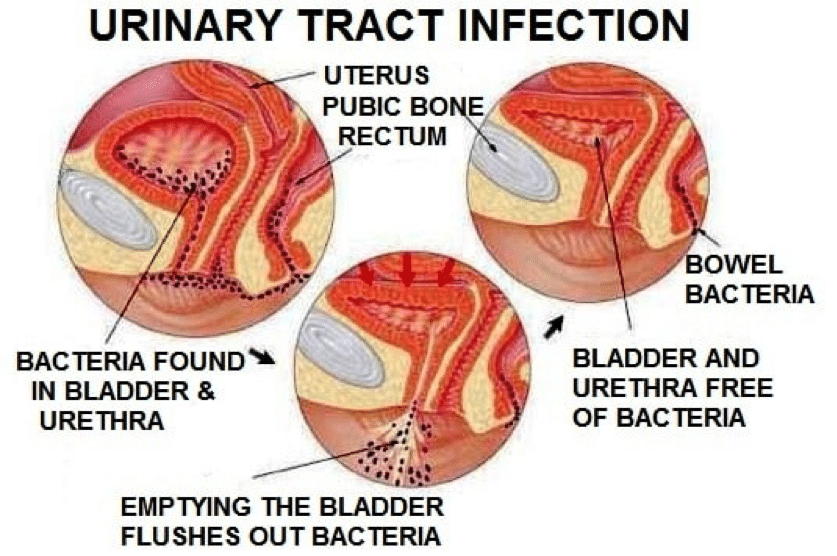 Urinary Tract Infection Causes