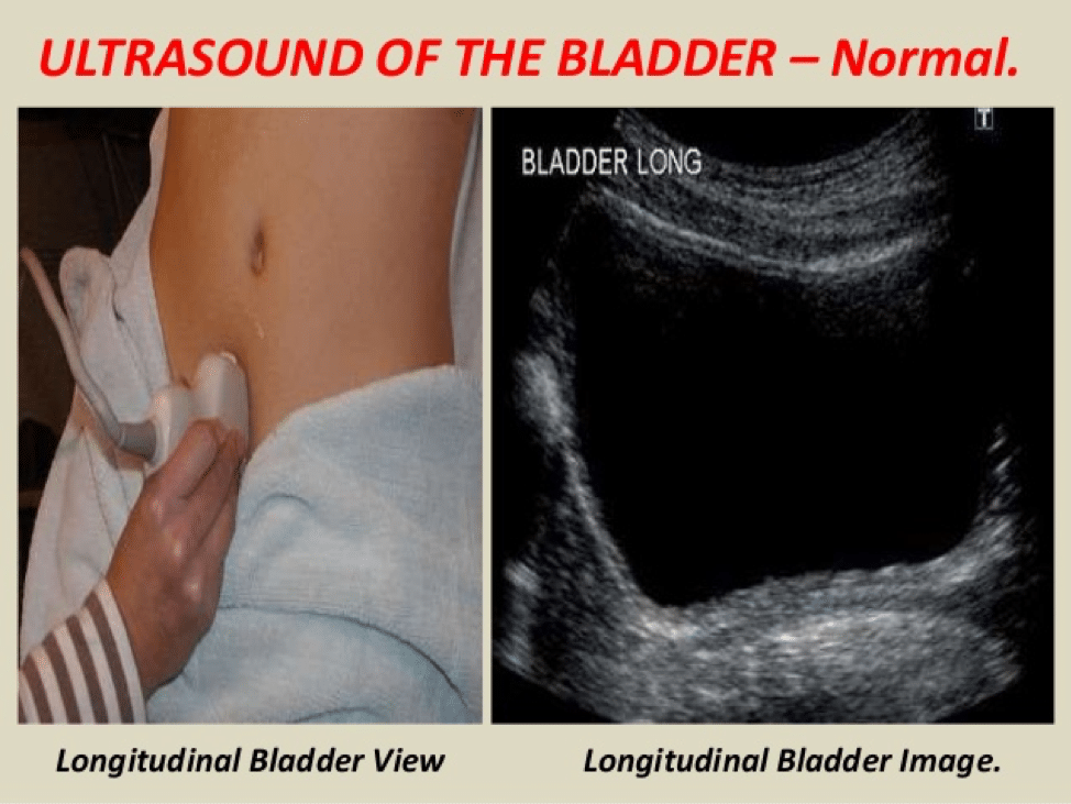 Urinary tract infection: ultrasound of the bladder